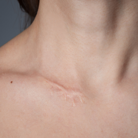 Une femme montre une cicatrice au niveau de la clavicule