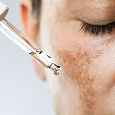 Une femme s'applique un sérum sur le visage afin de réduire ses taches pigmentaires
