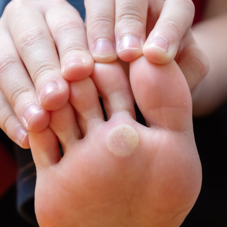 Retrouvez nos soins contre les verrues sur Pharmazon.fr !