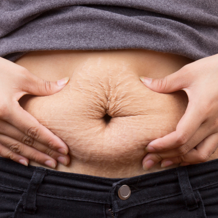 Le ventre d'une femme après la grossesse