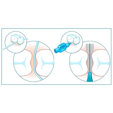 schéma de l'utilisation d'une brossette interdentaire